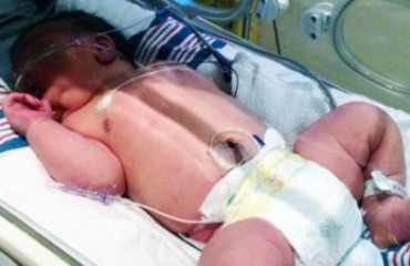 多倫多巨嬰 觀察1月後出院
